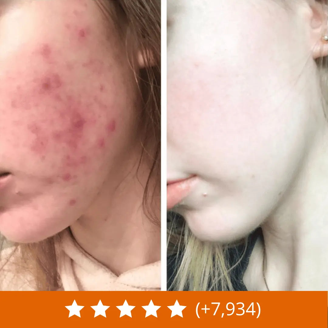 Rituel pour éliminer l'acné et les rougeurs