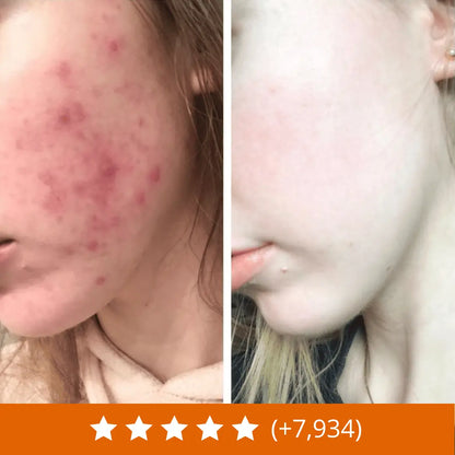 Rituel pour éliminer l'acné et les rougeurs